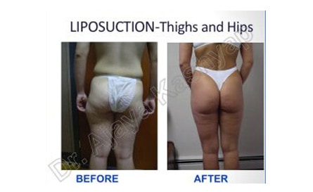 best liposuction india