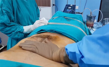 rhinoplasty in India